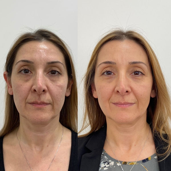 Pas de botox. Pas de chirurgie. Pas de routines avec +15 produits a 200€. Juste des nutriments purs.